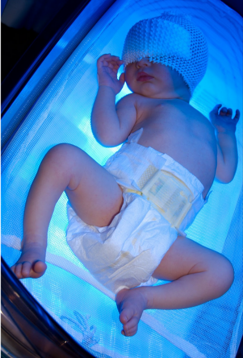 علاج الصفراء عند الاطفال حديثي الولادة